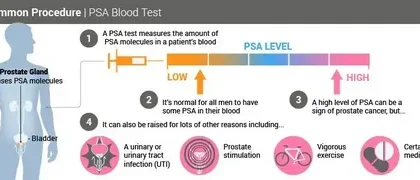 what is a dangerous psa level after prostate removal